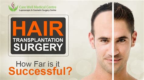 How To Know Hair Transplant Is Successful