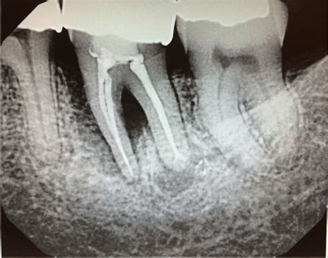 Implant Procedure By Dr Chaulong Los Altos Dental Excellence