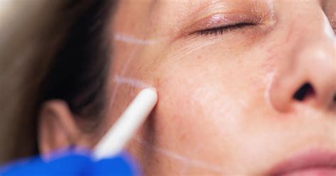 what is a thread lift the pros and cons of facial threading