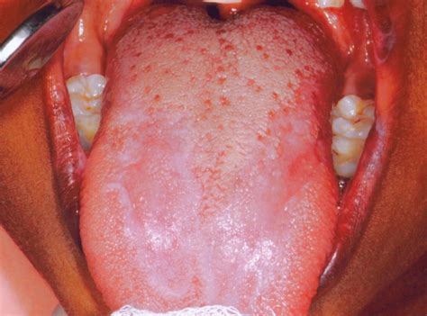 Oral Lichen Planus Causes Symptoms Treatment Risk Factors And Pictures