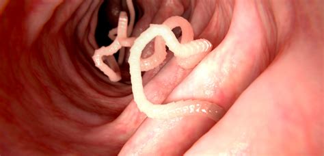 Tapeworms Pinworms Infection Symptoms Treatment Tests And Preventions