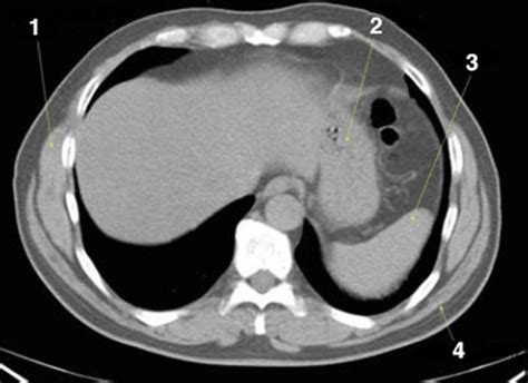 Image Noncontrast Ct Scan Of The Abdomen And Pelvis Showing Normal