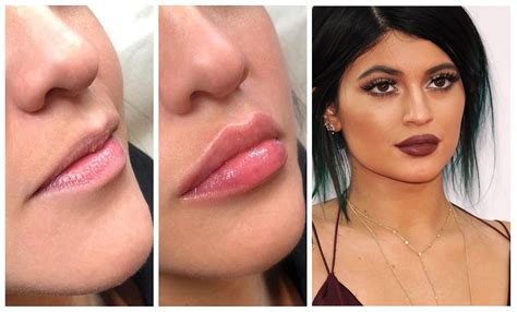 Meet Lip Threads The New Lip Fillers That Promise You A Better Pout Lip Fillers Beauty