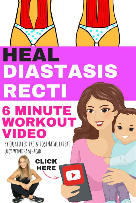 Diastasis Recti Also Known As ‘divarication Of The Recti Or Dra Is Widening Of The Gap