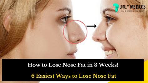 How To Lose Nose Fat In Weeks Easiest Ways To Lose Nose Fat