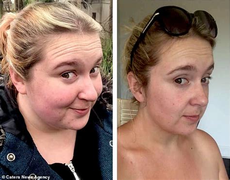 Woman Left With 15lbs Of Saggy Skin After Losing 12st Hopes To Raise £