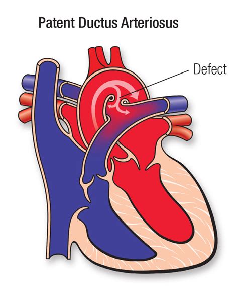 Patent Ductus Arteriosus Pda American Heart Association