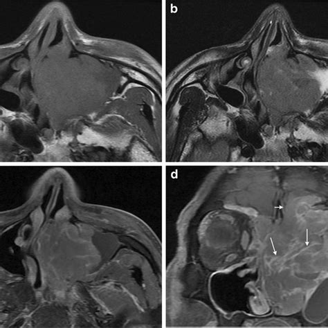 Mri Features Of Sinonasal Extranodal Nkt Cell Lymphomas And Diffuse
