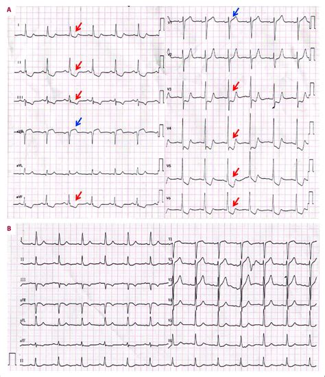 Twelve Lead Electrocardiogram Ecg Findings At Admission And After