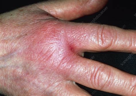 Cellulitis On Hand Stock Image M1300590 Science Photo Library
