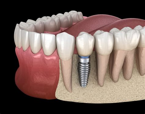 Single Tooth Implants In Sarasota Fl Sarasota Implant