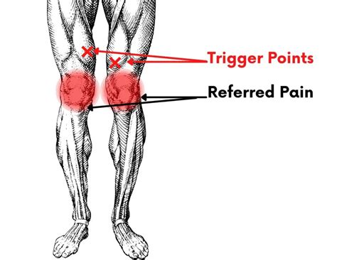 How To Recover From Quadriceps Injury Pain Above The Knee Facts