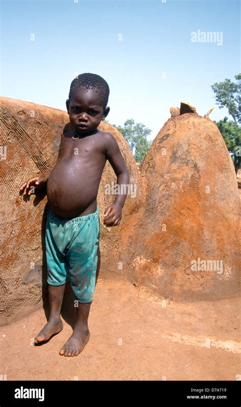 Marasmus Child Hi Res Stock Photography And Images Alamy