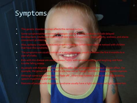 Famous People With Angelman Syndrome Acne Symptoms
