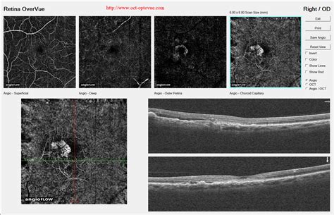 Oct Angiography And Armd