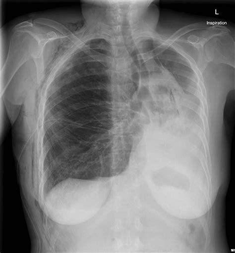 Lung Collapse Chest X Ray