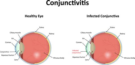 Conjunctivitis Common Eye Disorders Eyesite