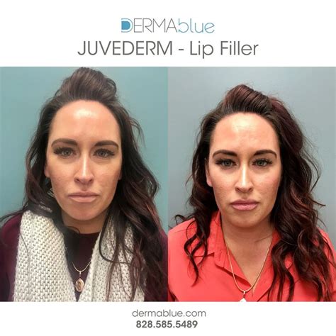 Juvederm Before And After Lip Fillers Juvederm Lips Juvederm