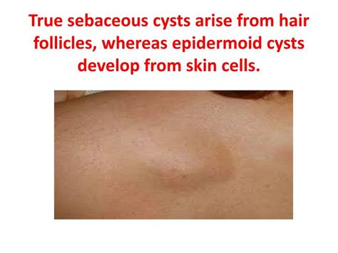 Ppt Sebaceous Cyst Removal In Hyderabad Powerpoint Presentation Id