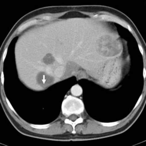 B Contrast Enhanced Axial Ct Scan Through The Liver At A Higher Level