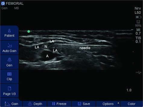 Ultrasound Guided Femoral Nerve Block Anesthesia Key