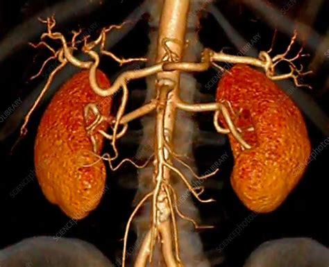 Healthy Kidneys 3d Ct Scan Stock Image C0527563 Science Photo