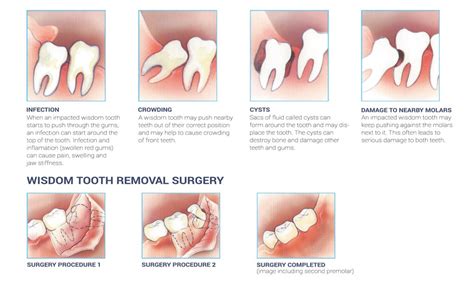 It's important to look after your. Impacted Wisdom Teeth | Wisdom Teeth Removal | Wisdom ...