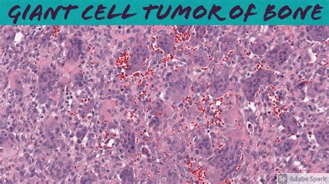 Giant Cell Tumor Of Bone Bone Pathology Basics Youtube