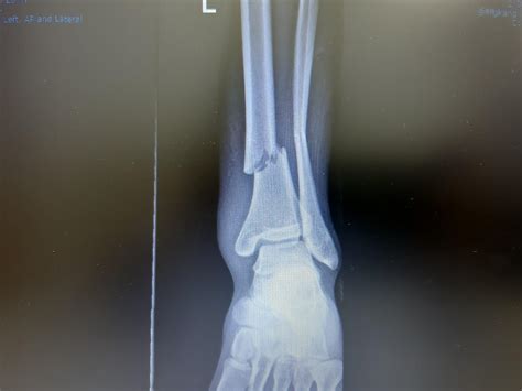 Tibia And Fibula Fracture Recovery My XXX Hot Girl