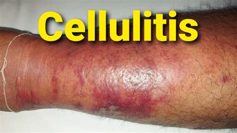 Cellulitis Of Leg Youtube