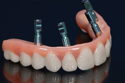 Hybrid Zirconia Dental Implants Zirconia Hybrid Dentures