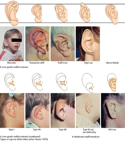 Disorders Of The External Ear Ento Key
