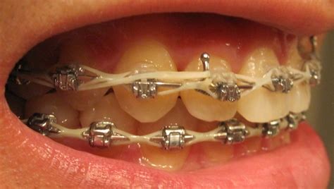 my journey with the damon braces week 105 with the damon braces