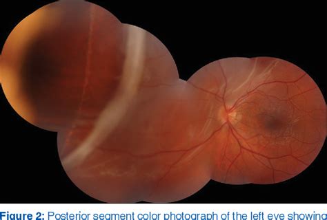 Figure 2 From Retinal Detachment With Spontaneous Dialysis Of The Ora