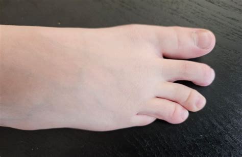 Pinky Toe Underlapping Causes Effects And Treatment Options