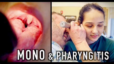 Mono And Pharyngitis Crazy Story Dr Paul Youtube