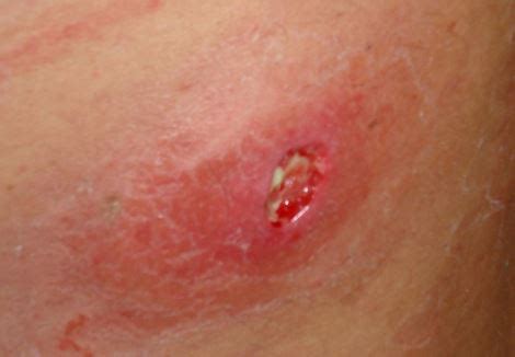 Ingrown armpit hairs may have various appearances. bouton d'acné dentifrice