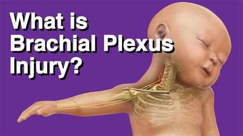 What Is Brachial Plexus Injury Youtube
