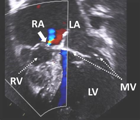 Diseases Of The Tricuspid Valve Thoracic Key