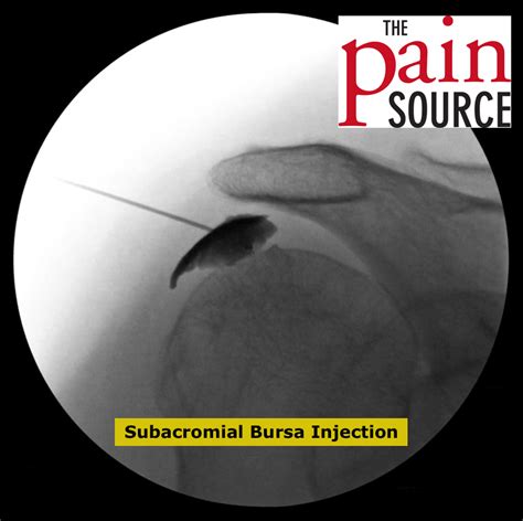 VIDEO Subacromial Bursa Injection Under Fluoroscopy The Pain Source Makes Learning About