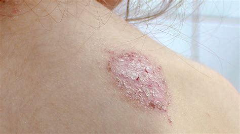 Nummular Eczema Treatment Over The Counter Severe Eczema Treatments