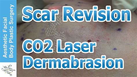 Laser Scar Revision With Co2 Laser Part 02 By Dr Philip Young Bellevue