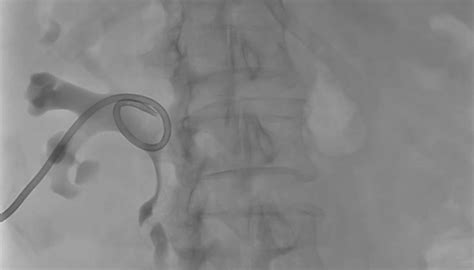 Percutaneous Nephrostomy For A Non Dilated Collecting System Backtable