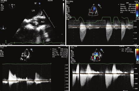 Echocardiogram Showing Severe Calcification Of Mitral Valve Aortic