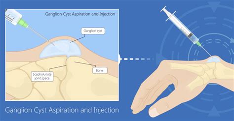 Aspiration Of Ganglion Cyst Is It Worth It Sport Doctor London