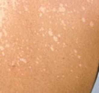 Human skin is very disposed to an assortment of conditions, with white spots being only one of many. White Spots on Body, Causes, Small, Sun, Fungus, Tanning ...
