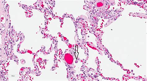 Histology Alveolar Macrophages Treatment And Management Point Of Care
