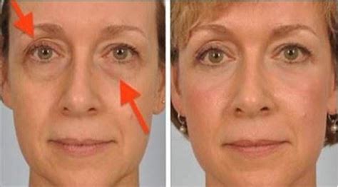 Solve Your Sagging Eyelids Problem Naturally In 2 Minutes Sagging