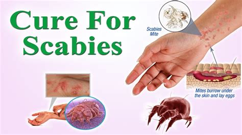Scabies Causes Symptoms Treatment Pictures Images