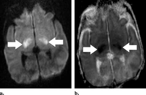 Hypoxic Ischemic Brain Injury Imaging Findings From Birth To Adulthood